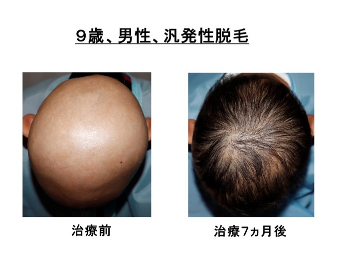 円形脱毛症　病院
